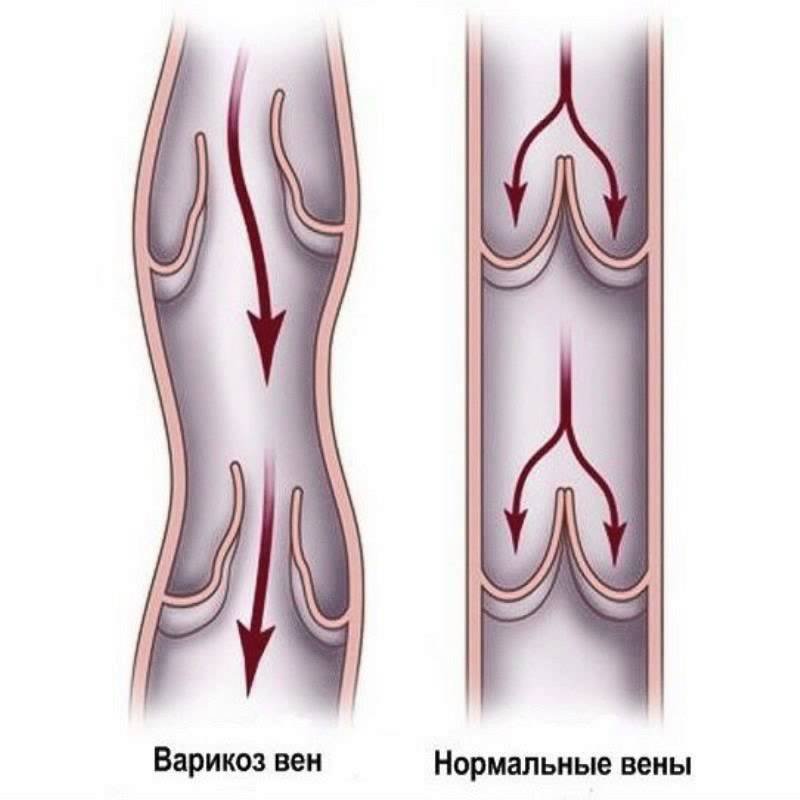 Варикозное расширение вен на ногах